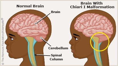 <p>Downward displacement of cerebral structures</p><p>Cerebellum, medulla oblongata, and the 4th ventricle are displaced into the cervical canal causing obstruction to CSF flow and resulting in <strong>Hydrocephalus</strong></p>