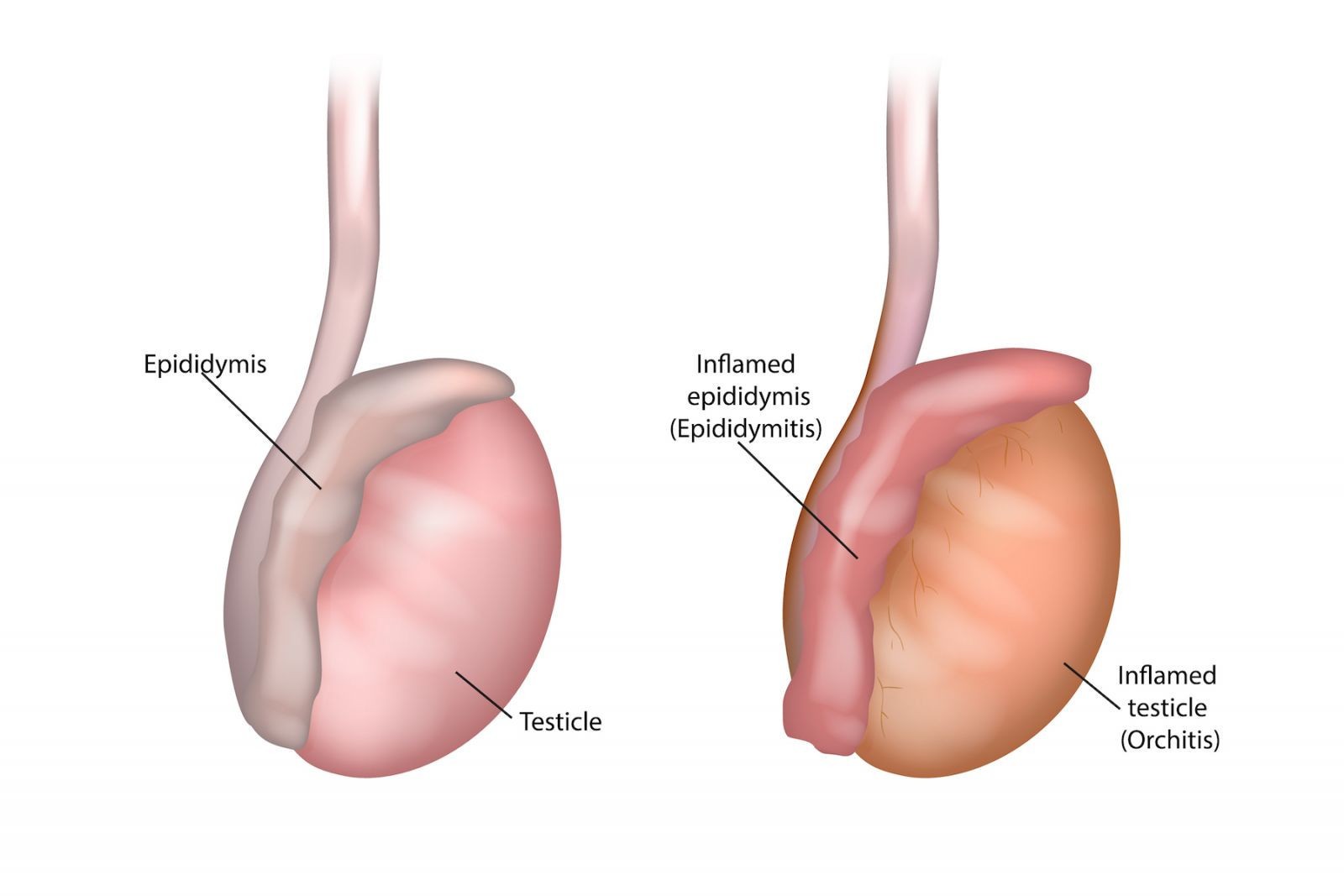 <p><strong>– </strong>tube at back of testicle that stores and carries the sperm is inflamed; caused by bacteria; most common causse of pain in scrotum</p>