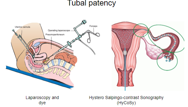 <p><strong>Laparoscopy</strong> is a minimally invasive surgical procedure that involves inserting a small camera (laparoscope) through small incisions in the abdomen to examine the internal organs, such as the uterus, ovaries, and fallopian tubes.</p><p>It is commonly used for diagnosing and treating conditions like infertility, endometriosis, pelvic pain, and tubal blockages.</p>