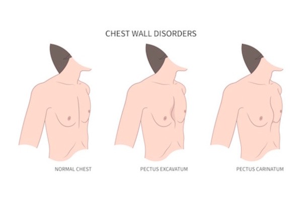 <p><strong>Pectus excavatum:</strong> funnel shaped chest, depression that <span class="tt-bg-yellow">sinks inward </span>is apparent at diploid process, progresses with growth. When pectus more pronounced, cardiac and pulmonary compression occurs</p><p><strong>Pectus carinatum</strong>: <span class="tt-bg-yellow">protuberance </span>of the chest wall, accounts for only 5 to 15% of anterior chest wall deformities </p>