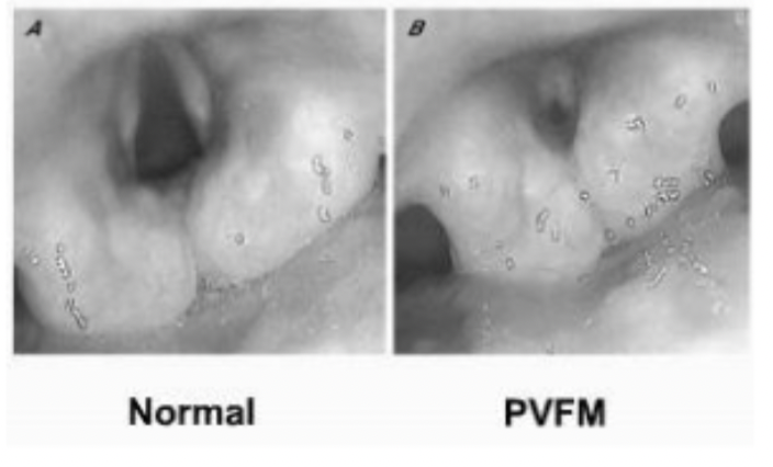 <p>• PVFM Symptoms: may be consistent or variable• Vocal-</p><p>◦ Breathy, weak phonation,◦ Hoarseness◦ Inspiratory stridor• Nonvocal-</p><p>◦ Throat tightness,◦ Wheezing◦ Chest tightness◦ Shortness of breath◦ Cough</p>