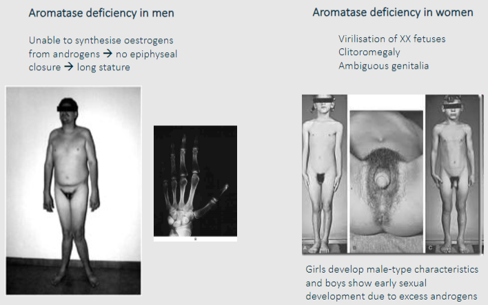 <p>✿In men with aromatase deficiency, the inability to convert androgens into estrogens leads to a lack of estrogenic effects. This results in a failure of epiphyseal closure, leading to abnormally long stature.</p><p>✿Due to excess androgens in aromatase-deficient individuals, girls may develop male-type characteristics such as increased body hair growth (hirsutism) and deepening of the voice, while boys may experience early sexual development.</p><p>✿In XX fetuses with aromatase deficiency, excess androgens can cause virilization, leading to clitoromegaly (enlarged clitoris) and ambiguous genitalia.</p><p>✿However, the consequences of aromatase deficiency in women may vary depending on the severity and timing of the deficiency, potentially leading to a spectrum of phenotypes ranging from mild to severe virilization.</p>