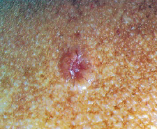 Usually starts as a small, pink or red papule (may be deeply pigmented)
with a pearly translucent top and overlying telangiectasia (broken blood
vessel). Then develops rounded, pearly borders with central red ulcer or
looks like large open pore with central yellowing. Most common form of
skin cancer; slow but inexorable growth. 
