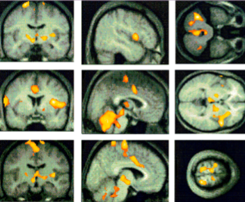 <p>✶The activation pattern during micturition is superimposed on averaged MRI scans.</p><p>✶A widespread involvement of cortical and subcortical areas including the specific pontine micturition centre (PMC) is observed.</p>