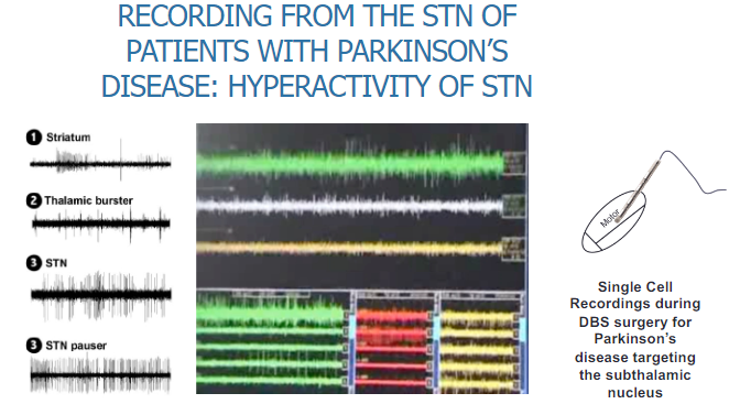 <p>Hyperactivity of the STN is observed in Parkinson’s disease patients.</p><p>Single-cell recordings are conducted during DBS (Deep Brain Stimulation) surgery, specifically targeting the subthalamic nucleus, to measure this hyperactivity.</p>