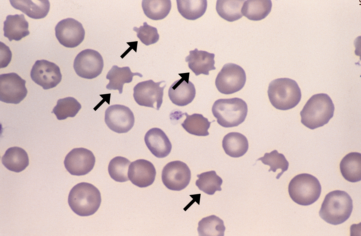 <p><strong>Spur Cell Anaemia:</strong></p><p>Characterized by spur cells <span class="tt-bg-red">(acanthocytes)</span> in the blood.</p><p>Irregularly shaped cells with spikelike projections.</p><p></p><p><strong>Association with Lipid Metabolism:</strong></p><p>Often <span class="tt-bg-yellow">linked to disorders affecting lipid metabolism.</span></p><p>Abnormalities in cholesterol and lipoprotein metabolism.</p>