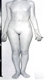 <p>♥︎A condition produced in genetically male people by the failure of tissue to respond to male sex hormones, resulting in normal female anatomy but with testes in place of ovaries.</p>