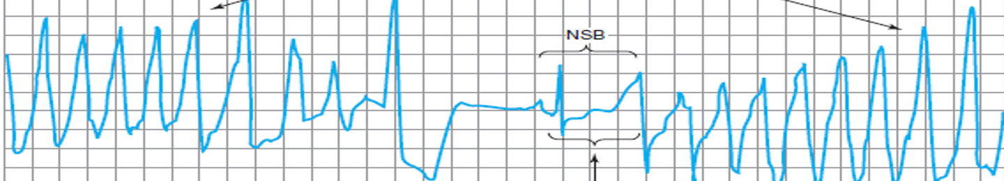 <p>a) premature atrial contraction (PAC)</p><p>b) atrial flutter</p><p>c) atrial fibrillation</p><p>d) torsades de pointes</p><p>e) ventricular fibrillation</p>