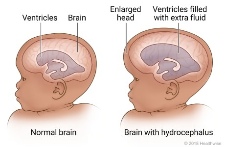 <p>imbalance in the production and absorption of the CSF; obstruction to the flow of CSF</p><p>-increased head size</p><p>-loss of developmental milestones</p><p>-changes in personality in older children</p><p>MAY REQUIRE SURGICAL INTERVENTION TO RELIEVE PRESSURE WITH A <strong>VENTRICULAR SHUNT </strong></p>