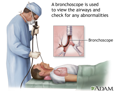 <p>Bronchoscopy involves the insertion of a bronchoscope down the trachea to enter a main bronchus.</p>