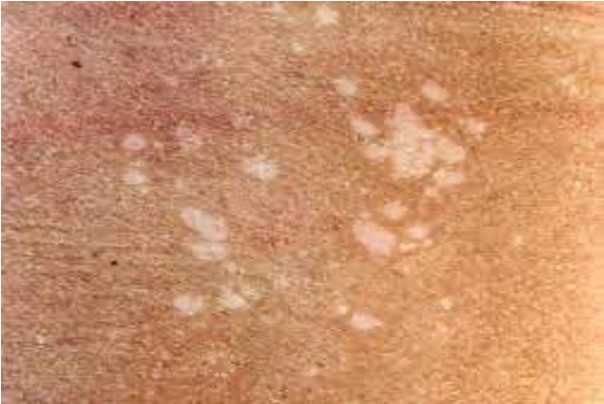 <p>presents differently; hypopigmentation lesions on upper body</p>