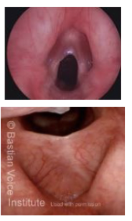 <p>Laryngeal Web: A sheet of tissue between the vocal folds usually at the anterior end.Etiology:◦ May be a result of forceful mechanical trauma or chronic infection when laryngeal tissue forms between the vocal folds.◦ NOTE: May also be congenital (we will look at this later) Characteristics:◦ Perceptual –hoarseness, high pitch (potentially secondary to the shortening of the effective vibratory length of the vocal fold due to the attachment of the vocal web◦ Acoustics –no definitive data available...what do you anticipate you will hear?</p>