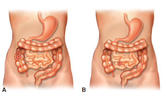 <p>&nbsp;proximal segment of bowel telescopes into more distal section; partial or total bowel obstruction;</p><p><em><u><span class="tt-bg-red">currant(red)-jelly stools; sausage shaped mass is hallmark sign</span></u></em></p>