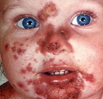 Moist, thin-roofed vesicles with thin, erythematous base. Rupture to form erosions and thick, honey-colored crusts. Highly contagious bacterial infection of skin; most common in infants and children. Infection can spread to other body areas and other children and adults by direct contact

