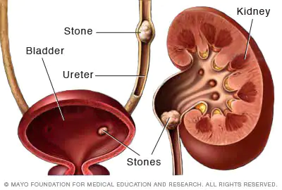 <p>✶Kidney stones can form anywhere within the urinary tract, including the kidney, ureter, or bladder.</p><p>✶Symptoms may include <span class="tt-bg-yellow">dysuria</span> (painful urination), <span class="tt-bg-red">hematuria </span>(blood in the urine), <span class="tt-bg-blue">loin pain or back pain</span>, <span class="tt-bg-yellow">reduced urine flow,</span> and <span class="tt-bg-blue">urinary tract obstruction</span>.</p><p>✶Urinary tract obstruction caused by kidney stones can lead to considerable pain, known as <span class="tt-bg-red">renal colic</span>, with pressures reaching up to <span class="tt-bg-red">50 mmHg</span>.</p><p>✶As the stone approaches the tip of the urethra, intense pain can inhibit micturition, a condition known as <span class="tt-bg-yellow">strangury</span>.</p>