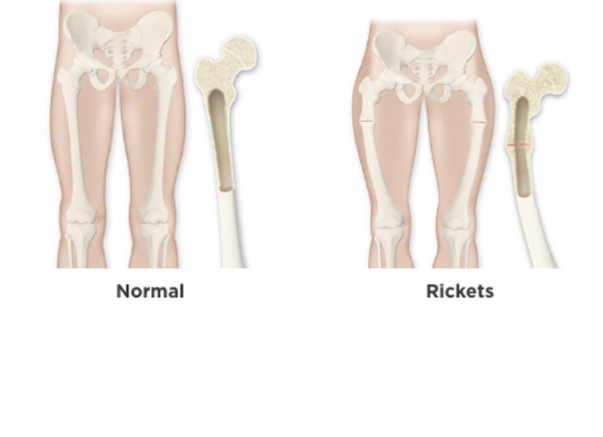 <p>-Softening or weakening of the bones</p><p>-Childhood rickets may occur as a result of nutritional deficiencies such as inadequate consumption of calcium or vitamin D or limited exposure to sunlight (required for adequate production of vitamin D).</p><p>﻿Rickets caused by vitamin D deficiency is a preventable condition</p>