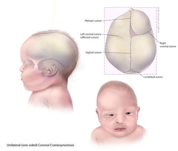 <p>Premature closure of the sutures</p>