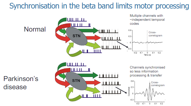 <p>Synchronization in the beta band within the basal ganglia is associated with a reduction in motor processing, leading to motor dysfunction such as bradykinesia in Parkinson's disease.</p><p>Excessive beta-band synchronization impairs the ability of the motor system to process and execute smooth, coordinated movements.</p>