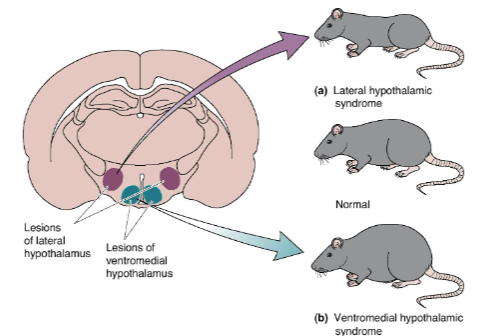 <p><strong>Lateral hypothalamic syndrome (LH lesion)</strong>: Results in <strong>diminished appetite</strong> for food, leading to <strong>anorexia</strong>.</p><p><strong>Ventromedial hypothalamic syndrome (VMH lesion)</strong>: Leads to <strong>overeating</strong> and <strong>obesity</strong> due to impaired satiety signaling.</p><p>Both syndromes are related to disruptions in <strong>leptin signaling</strong>, which plays a key role in regulating hunger and energy balance.</p><p>The LH is typically involved in hunger signals, while the VMH is responsible for signaling satiety.</p>