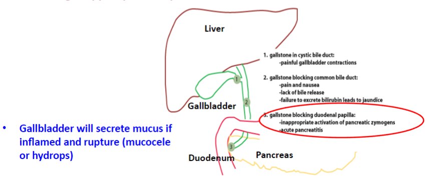 <p>★Impairment of the neck of the cystic duct can lead to biliary pain in the right upper quadrant, a condition known as acute cholecystitis.</p>