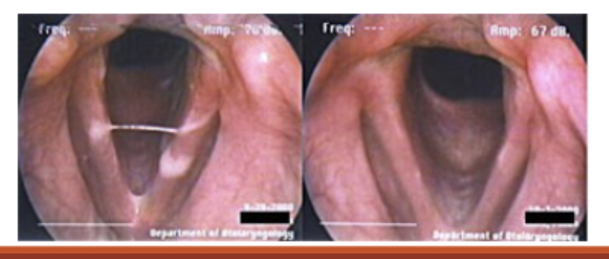 <p>◦Laryngitis: an inflammation of the vocal folds and larynx◦ Etiology: phonotrauma overexposure to noxious agents (tobacco, alcohol, drugs); GERD, LPR, environmental agents (allergens, dust).◦ May be acute (resulting from bacterial or viral infection) or chronic (vocal abuse/misuse).</p>