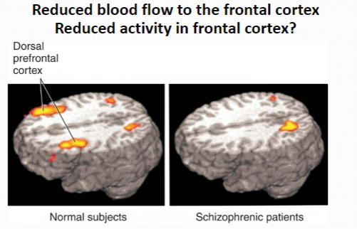 <p><strong>Role of the frontal cortex</strong>: Involved in <strong>higher cognitive functions</strong>, including <strong>decision making</strong>, <strong>planning</strong>, <strong>social behavior</strong>, and <strong>working memory</strong>.</p><p><strong>Symptoms related to reduced frontal activity</strong>:</p><p><strong>Cognitive deficits</strong> (e.g., impaired memory and attention)</p><p><strong>Negative symptoms</strong> (e.g., lack of motivation, social withdrawal)</p><p><strong>Difficulty with executive functioning</strong> (e.g., poor decision making, inability to plan or organize)</p>