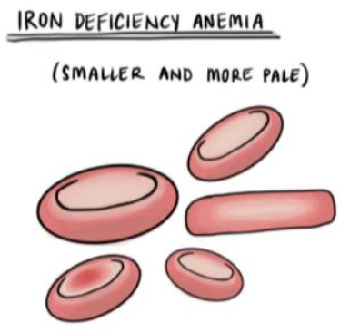 <p>Turns them into microcytic (smaller) and hypochromic (less red/paler) RBCs.</p>