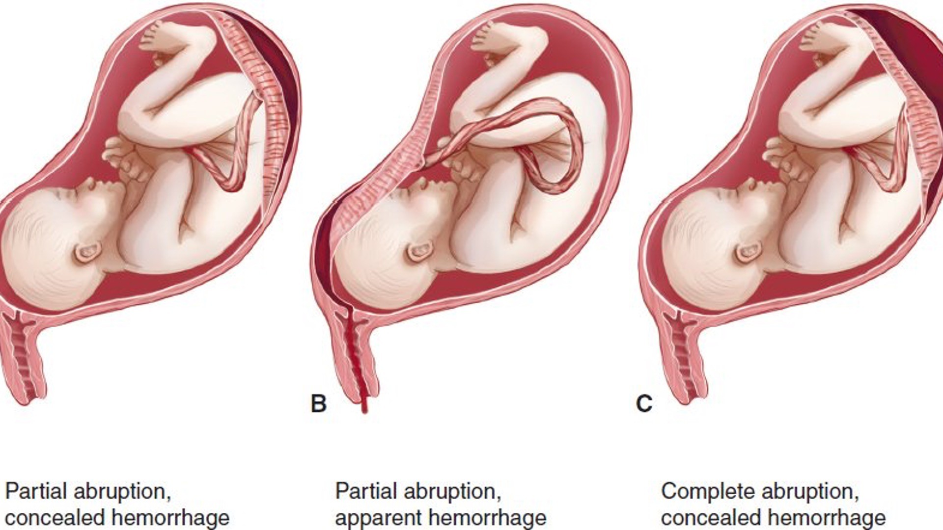 <p>•<strong><em><span class="tt-bg-red">Premature separation </span></em></strong>of normally implanted placenta from uterine wall</p><p>•Associated Factors<strong>:</strong></p><p>•Drug use; Cocaine</p><p>•Hypertension</p><p>•Trauma</p><p>•Hydramnios</p><p><strong><span class="tt-bg-red">Symptoms</span></strong></p><p><strong><span class="tt-bg-red">•Dark venous blood</span></strong></p><p><strong><span class="tt-bg-red">•Abdomen rigid, hard</span></strong></p><p><strong><span class="tt-bg-red">•Severe pain</span></strong></p><p><strong><span class="tt-bg-red">•Sudden onset</span></strong></p>