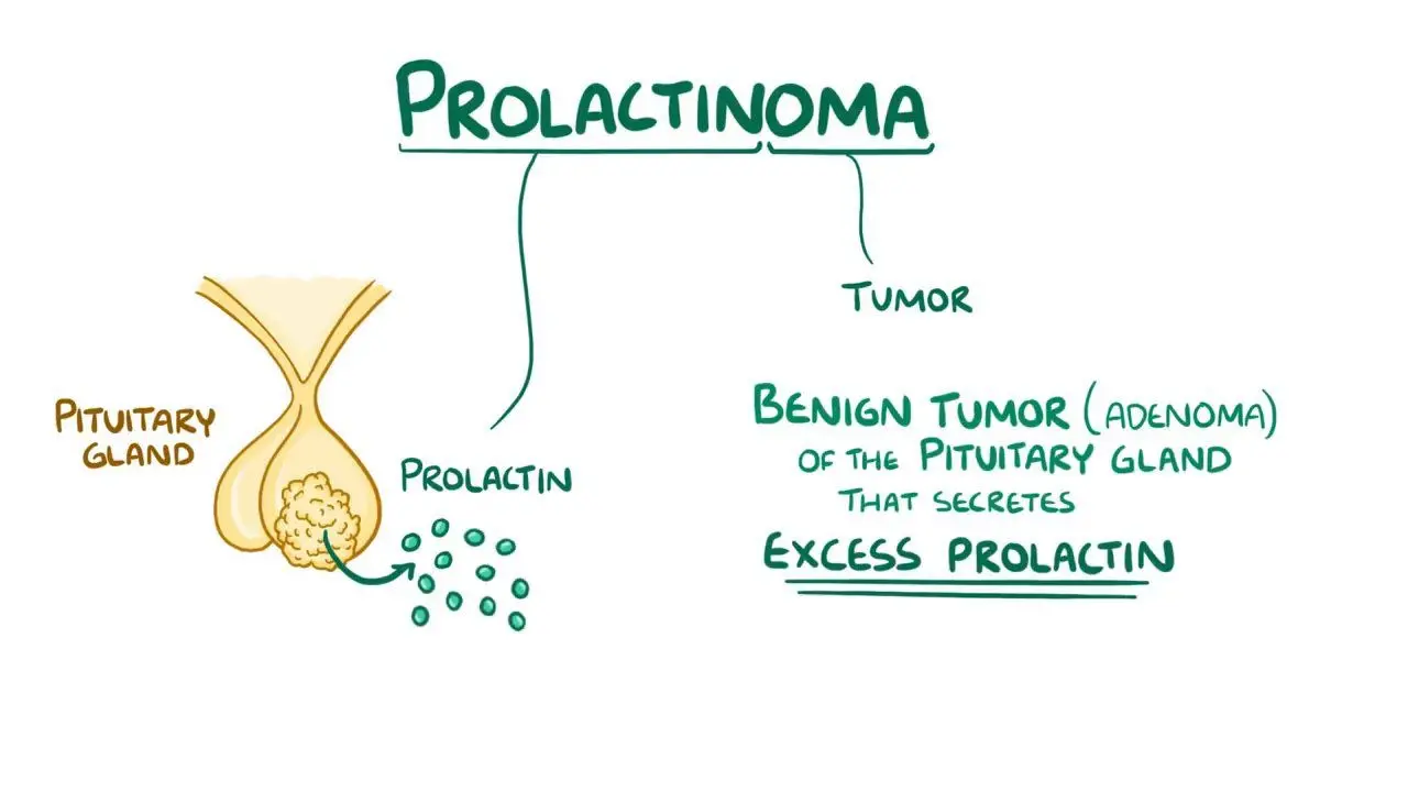 <p>Prolactinoma is the syndrome characterized by the overproduction of prolactin due to tumors of the anterior pituitary gland.</p>