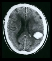 <p><strong>Penetrating brain injury</strong>: Trauma that directly affects the language-related regions of the brain.</p><p><strong>Cerebral haemorrhage</strong>: Bleeding in the brain, affecting language comprehension and production areas.</p>