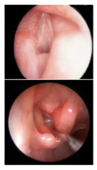 <p>◦ Connective tissue in subglottic, glottic, and supraglottic regions◦ Tissue that completely occludes the larynx at birth is known as laryngeal atresia ; airway must be opened immediately to prevent respiratory distress◦ Etiology: congenital webs are the result of a failure of the vocal fold tissue to separate during the first trimester of pregnancy.</p>