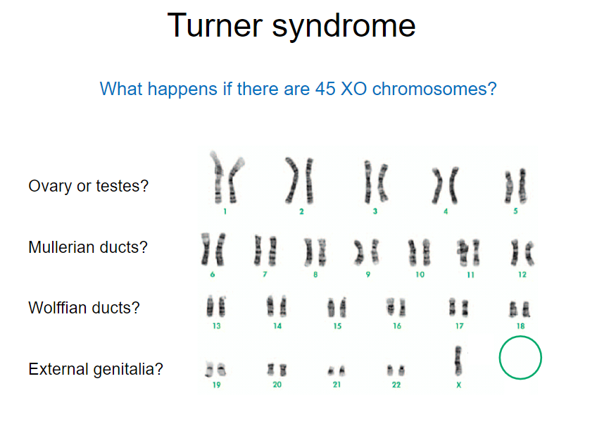 <p>Turner syndrome is characterized by a 45, XO karyotype, indicating the absence of one X chromosome.</p>