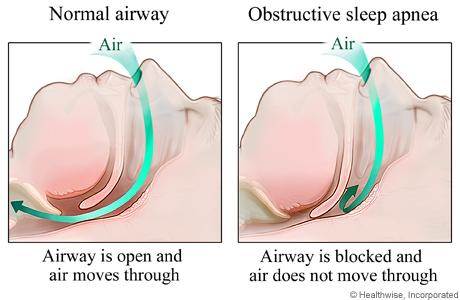 <p>Obstructive sleep apnea (OSA) can be a consequence of excess GH/IGF-I.</p>