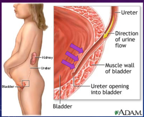 <p>✶Ureters open obliquely (at a downwards angle) into the bladder, preventing reflux of urine back into the ureters by a passive flap-valve effect.</p><p>✶Ureteric peristalsis is myogenic in origin and NOT under CNS control.</p><p>✶Coordination is required between peristalsis and changing urine volume.</p>