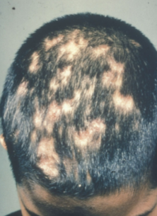 <p><strong>Tinea capitis</strong> is a <strong>fungal infection</strong> commonly known as <strong>scalp ringworm</strong>.</p><p>It primarily affects the <strong>scalp</strong> and can cause hair loss, itching, and scaly patches.</p>