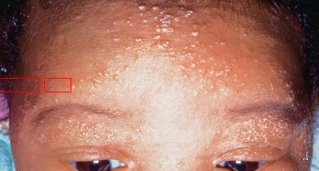 Tiny white papules on the forehead and eyelids, also on cheeks, nose, and chin. Sebum occuldes the opening of follicles, usually resolves spontaneously within a few weeks.
