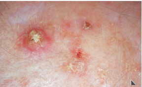 Arise from actinic keratoses or de novo. Erythematous
scaly patch with sharp margins, 1 cm or more. Develops central ulcer and
surrounding erythema. Usually on hands or head, areas exposed to UV
radiation; at right, on habitually sun-exposed bald scalp. Less common but grows rapidly
