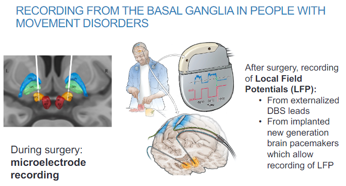 <p>Local Field Potentials (LFP) can be recorded from externalized DBS (Deep Brain Stimulation) leads.</p><p>New generation brain pacemakers implanted in patients also allow for LFP recording, providing continuous monitoring of basal ganglia activity.</p>