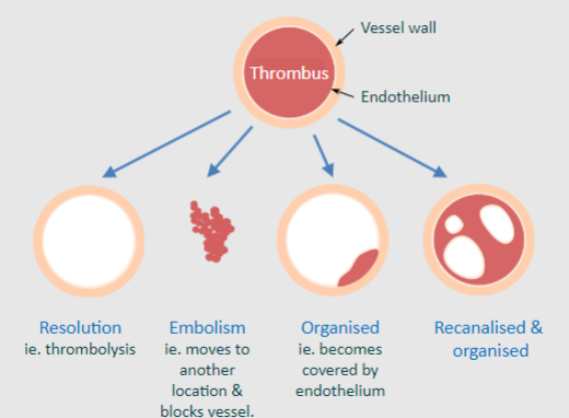 <p>♡ Thrombolysis occurs</p>