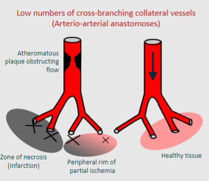 <p>-Functional end-arteries are arteries where decreased perfusion in one of them can cause major problems because they do not have adequate collateral circulation </p><p>-This is significant in Ischaemic Heart Disease because decreased perfusion in one of these arteries can lead to severe consequences</p>