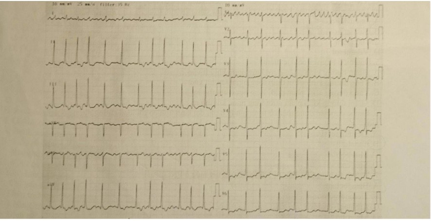 <p>13. Đọc điện tâm đô sau : </p><p>A. Nhip xoang không đều B. Rung nhi C. Nhip nhanh trên thát D. Tim nhanh nhĩ đa ổ</p>