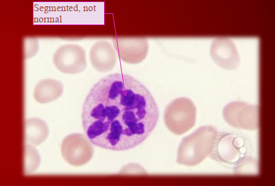 <p>Hyper-segmented neutrophils appear in ___.</p>