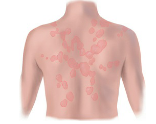 Lesions run together (e.g., urticaria [hives]).
