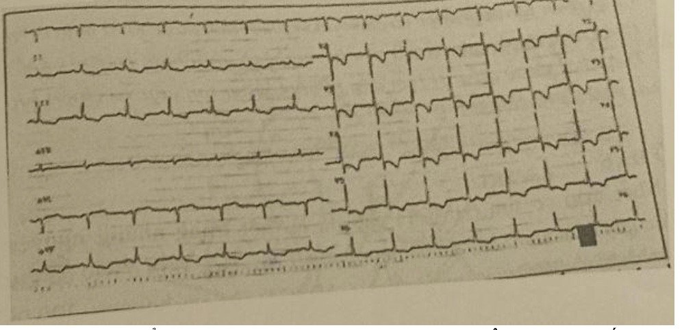 <p>25. BN nam 56 tuổi, Đau thắt ngực điển hình lúc 6 giờ sáng, cơn đau kéo dài 20 phút, sau đó hết đau, đau lại một cơn lúc 12 giờ, tự đến bệnh viện lúc 12 giờ 30, tiền sử THA. ĐTĐ, hút thuốc lá. BN đang được điều trị Statin, thuốc chữa ĐTĐ đường uống, thuốc THA và aspirin. Tình trạng nhập viện: đau ngực âm ỉ, tim 75ck/phút, HA 140/80 mmHg, phổi không ran, xét nghiệm hs-Troponin T : 0,15 n/L. Điện tâm như hình sau Tính theo thang điểm nguy cơ TIMI cho bệnh nhân ĐTNKÔĐ, BN này xếp vào nhóm </p><p>A. Nguy cơ cao&nbsp; B. Nguy cơ vừa&nbsp; C. Nguy cơ thấp D. Nguy cơ rất thấp</p>
