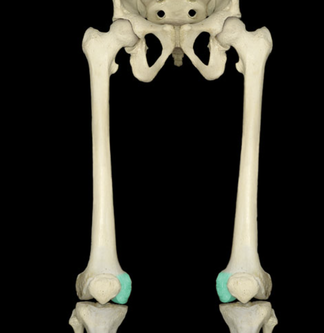 <p>of femur</p>