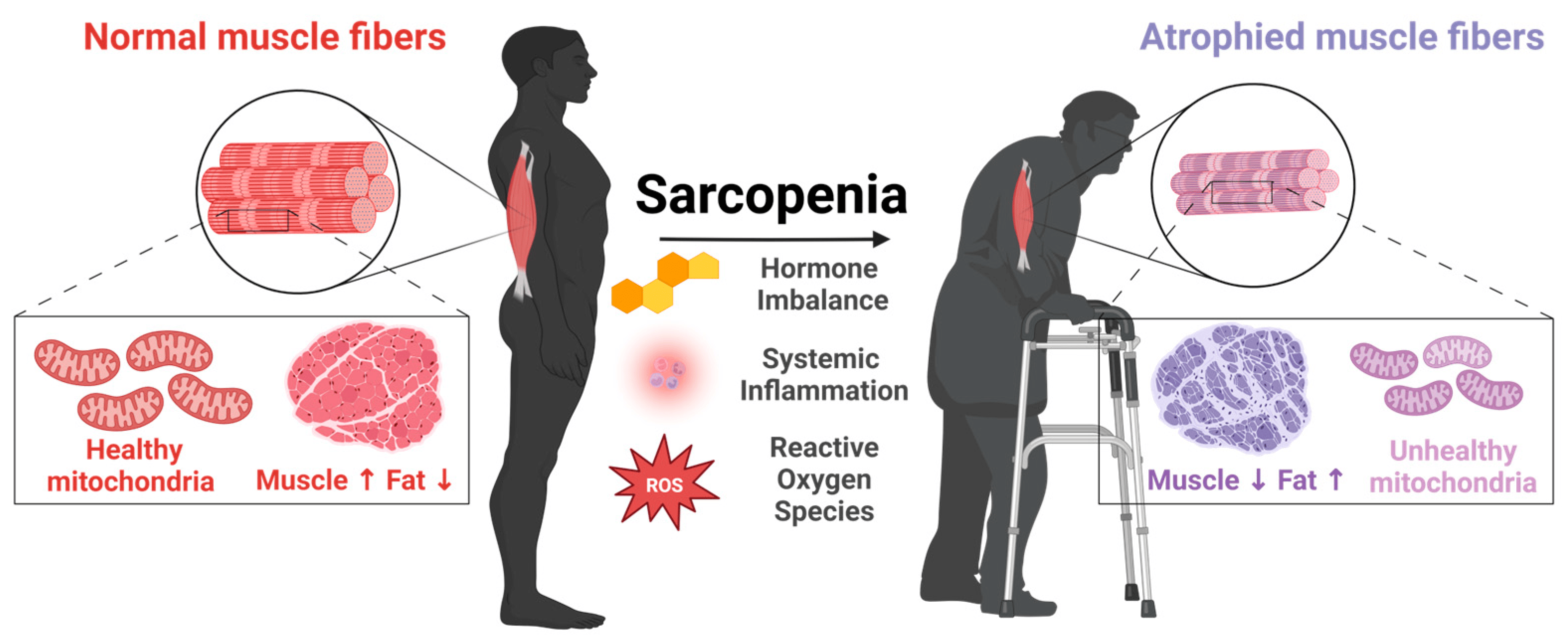 <p><strong>Sarcopenia</strong> is the reduction in <strong>muscle mass</strong> that occurs with ageing.</p><p>It is a <strong>normal part of the ageing process</strong>.</p><p><strong>Atrophy</strong> (shrinkage) of muscle fibres is a major feature of sarcopenia.</p><p>Sarcopenia may also result from <strong>disease</strong> or <strong>immobilization</strong>.</p><p>It is associated with <strong>decreased satellite cell number</strong> and <strong>recruitment</strong>, which are essential for muscle regeneration.</p><p><strong>Anabolic resistance</strong> occurs, where there is <strong>reduced protein synthesis</strong> in response to hormonal stimulation or <strong>resistance exercise</strong>.</p>