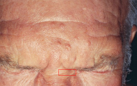 Raised yellow papules with a central depression. More common in men, occurring in forehead, nose, and cheeks. "Pebbly looking"
