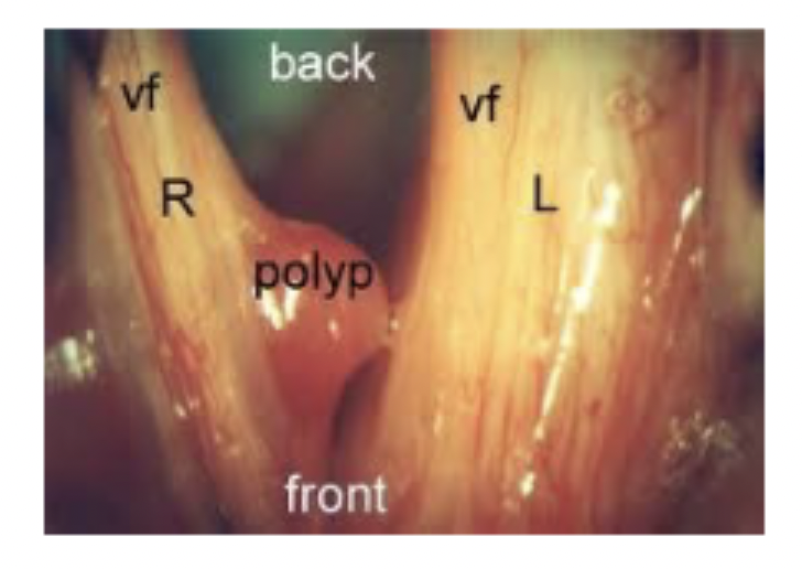 <p>Vocal Polyps: ◦fluid filled area under the mucosal layer believed to result from a period of vocal abuse but may occur from a single traumatic incident (i.e., yelling at a concert).◦Pedunculated polyp- localized and attached to the vocal fold by a slim stalk of tissue◦Sessile polyp- closely adhering to the mucosa◦Hemorrhagic polyp- has the appearance of a blood blister</p>