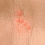 Elevated cavity containing free fluid, up to 1 cm; a
“blister.” Clear serum flows if wall is ruptured.
Examples: herpes simplex, early varicella (chickenpox),
herpes zoster (shingles), contact dermatitis.
