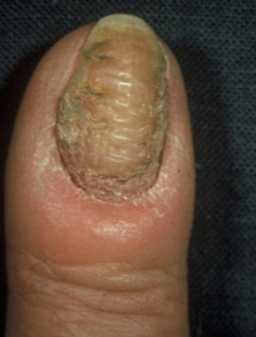 <p><strong>Paronychia</strong> is a <strong>nail fold infection</strong>, which can be caused by either <strong>fungal</strong> or <strong>bacterial</strong> infections.</p>